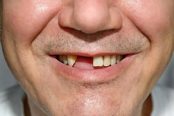 تعبیر خواب افتادن دندان ها برای زن متاهل + برای مرد و زن متاهل و پسر و دختر مجرد