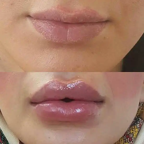تعبیر خواب ژل لب زدن + برای مرد و زن متاهل و پسر و دختر مجرد