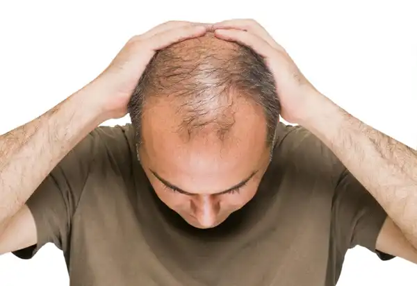 تعبیر خواب کچل شدن برای زن متاهل + برای مرد و زن متاهل و پسر و دختر مجرد