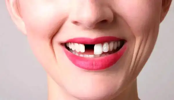 تعبیر خواب ریختن دندان برای زن متاهل + برای مرد و زن متاهل و پسر و دختر مجرد